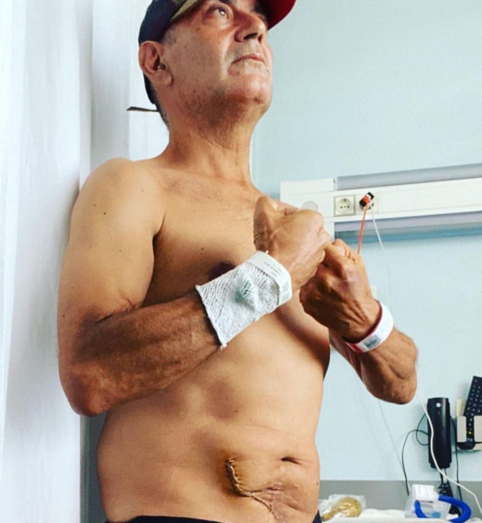 José Corbacho muestra la cicatriz de su trasplante de riñón y lanza una profunda reflexión