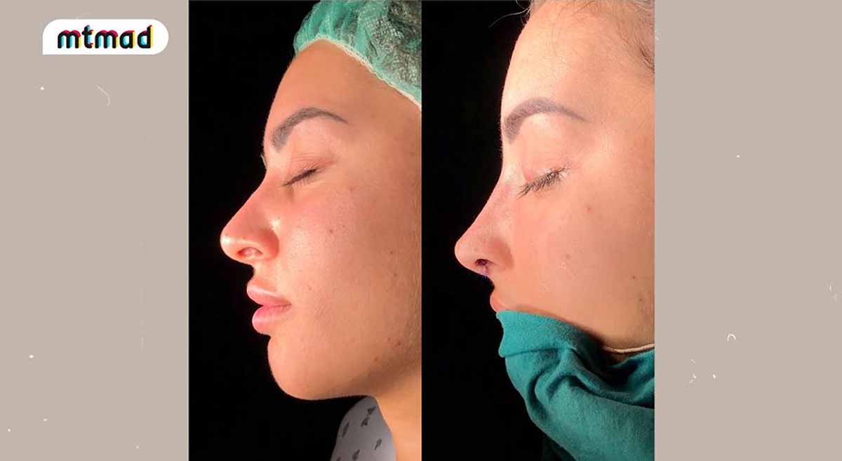 Marina enseña el asombroso antes y después de su nariz tras una nueva operación