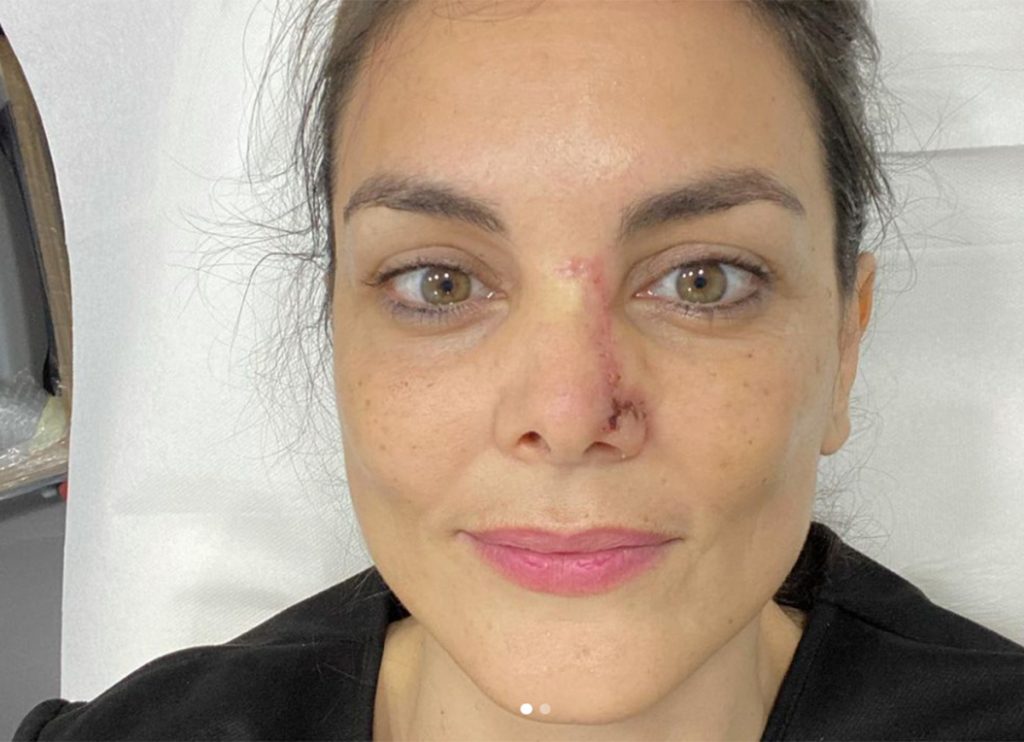 Mónica Carrillo muestra la cicatriz de su cáncer un año después y los famosos aplauden su valentía