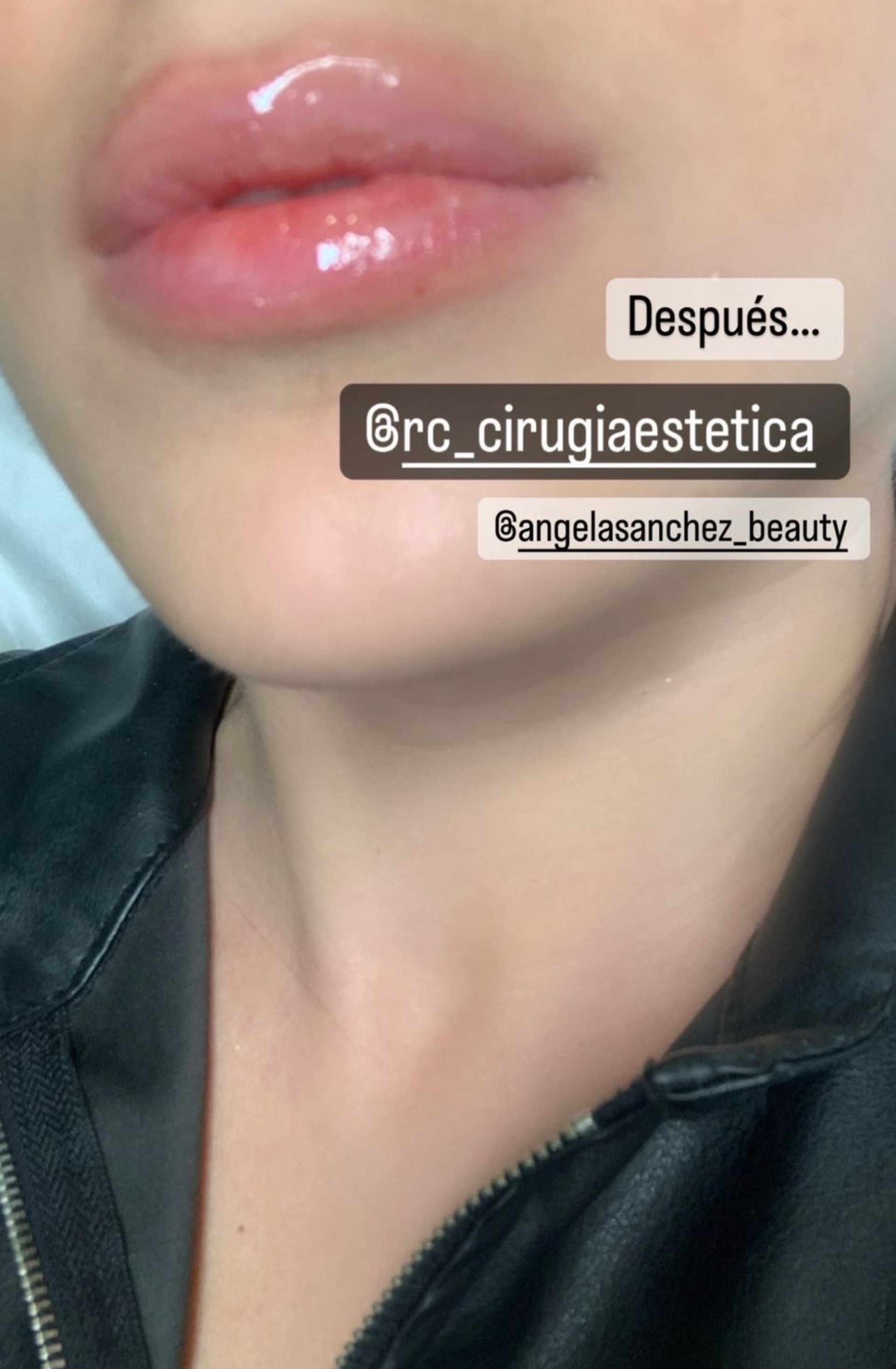 Marta Riesco retoque labios