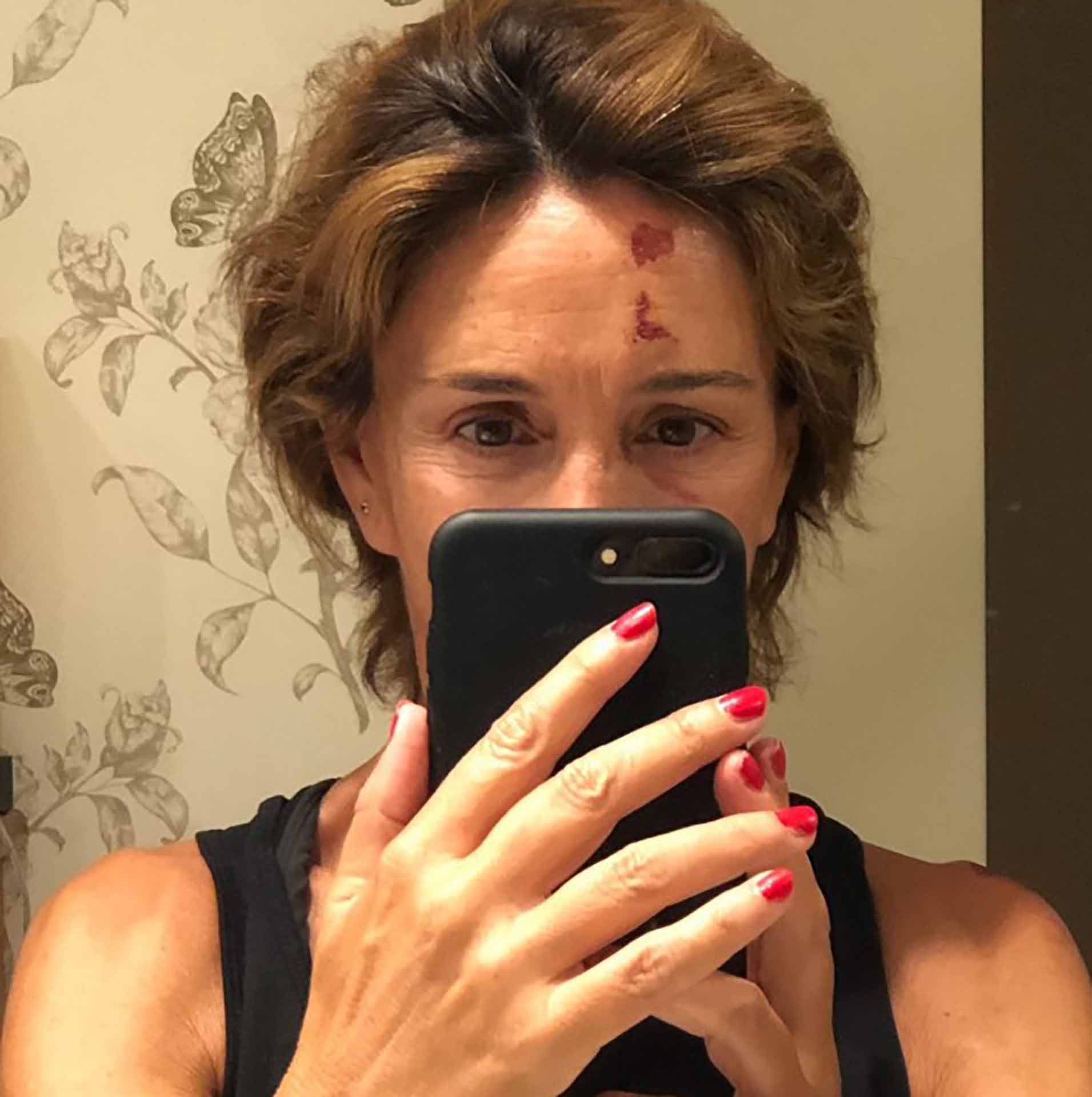 Lydia Bosch enseña las heridas de su cara tras sufrir un accidente de skate