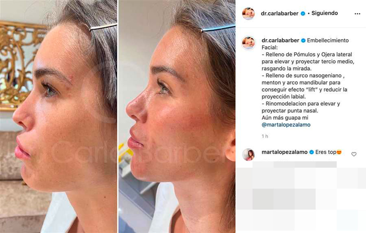Marta López Álamo enseña cómo era su nariz antes de operarse
