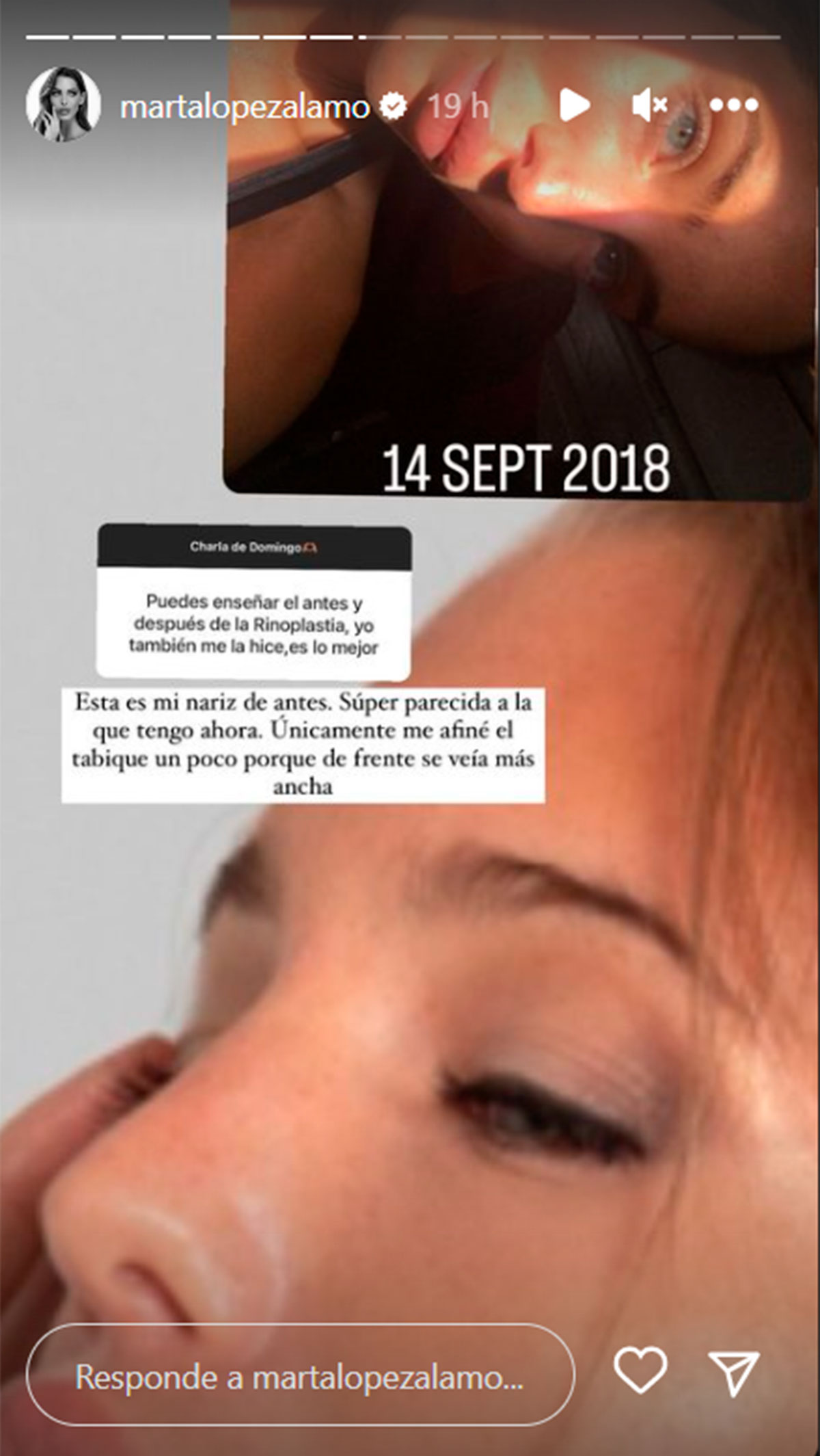 Marta López Álamo enseña cómo era su nariz antes de operarse