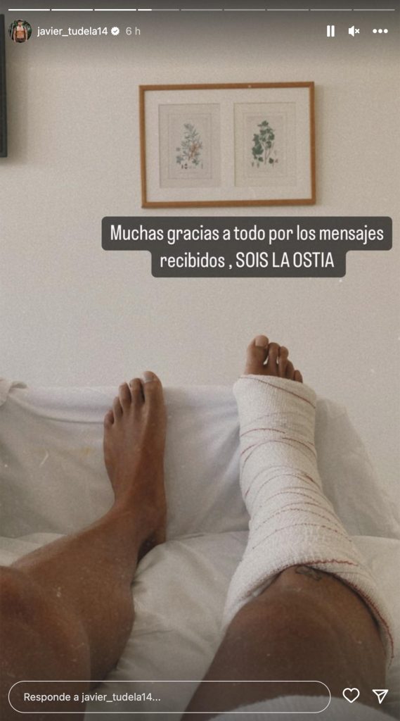El pie escayolado de Javier Tudela.