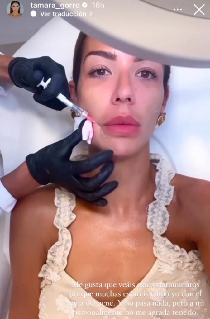 Tamara Gorro mesoterapia facial 