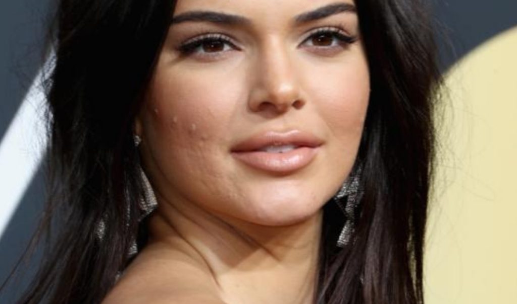 Kendall Jenner con marcas en el rostro de acné