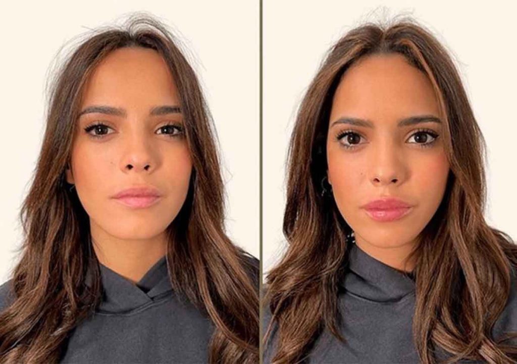 Antes y después de la inyección de labios de Gloria Camila