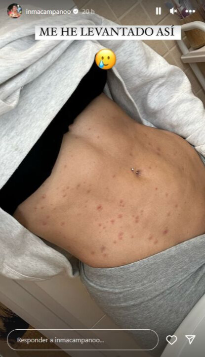 Inma Campano, su complicado diagnóstico de salud: Sarna, escarlatina y Gripe A
