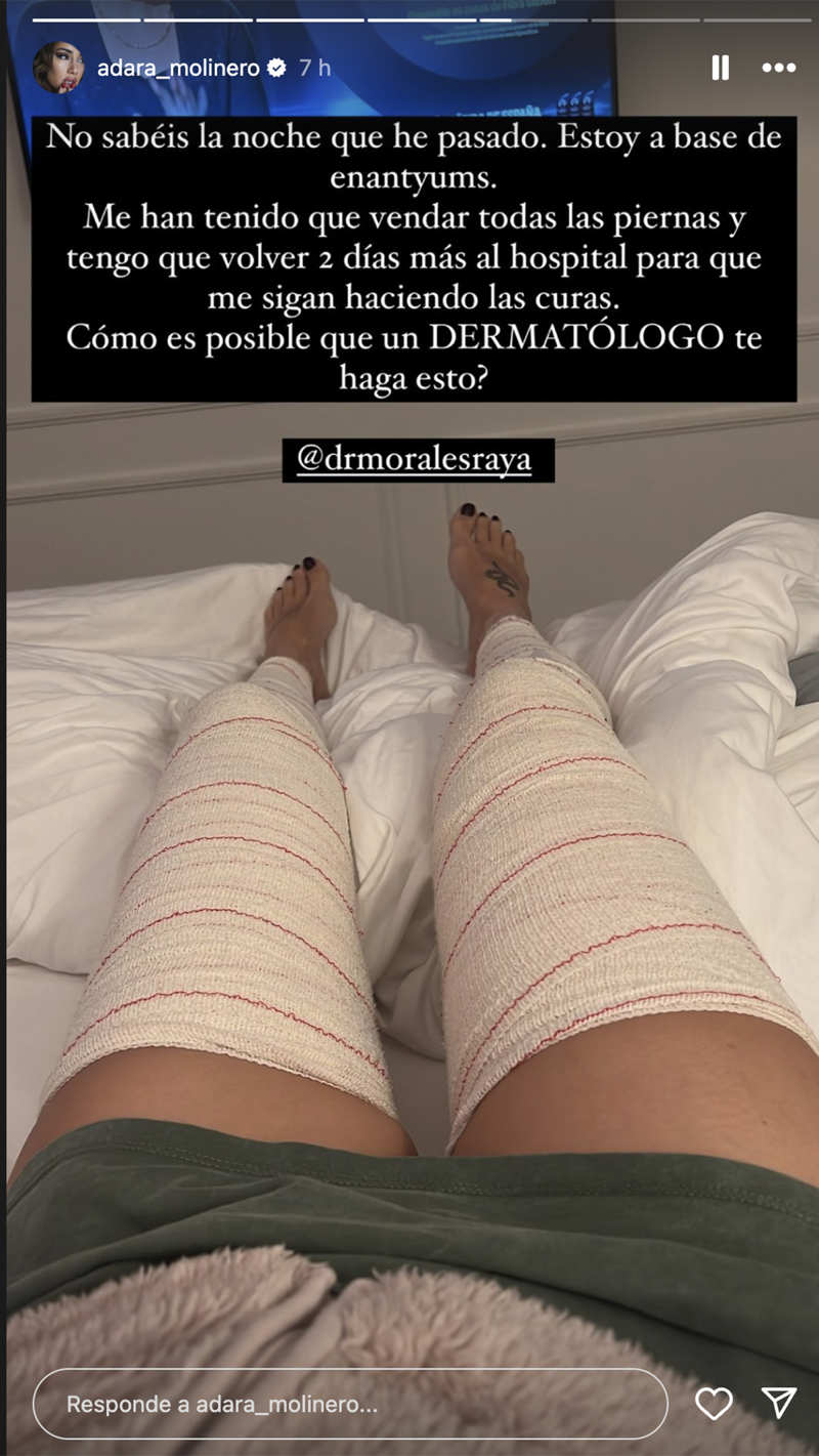 Adara Molinero muestra sus piernas vendadas