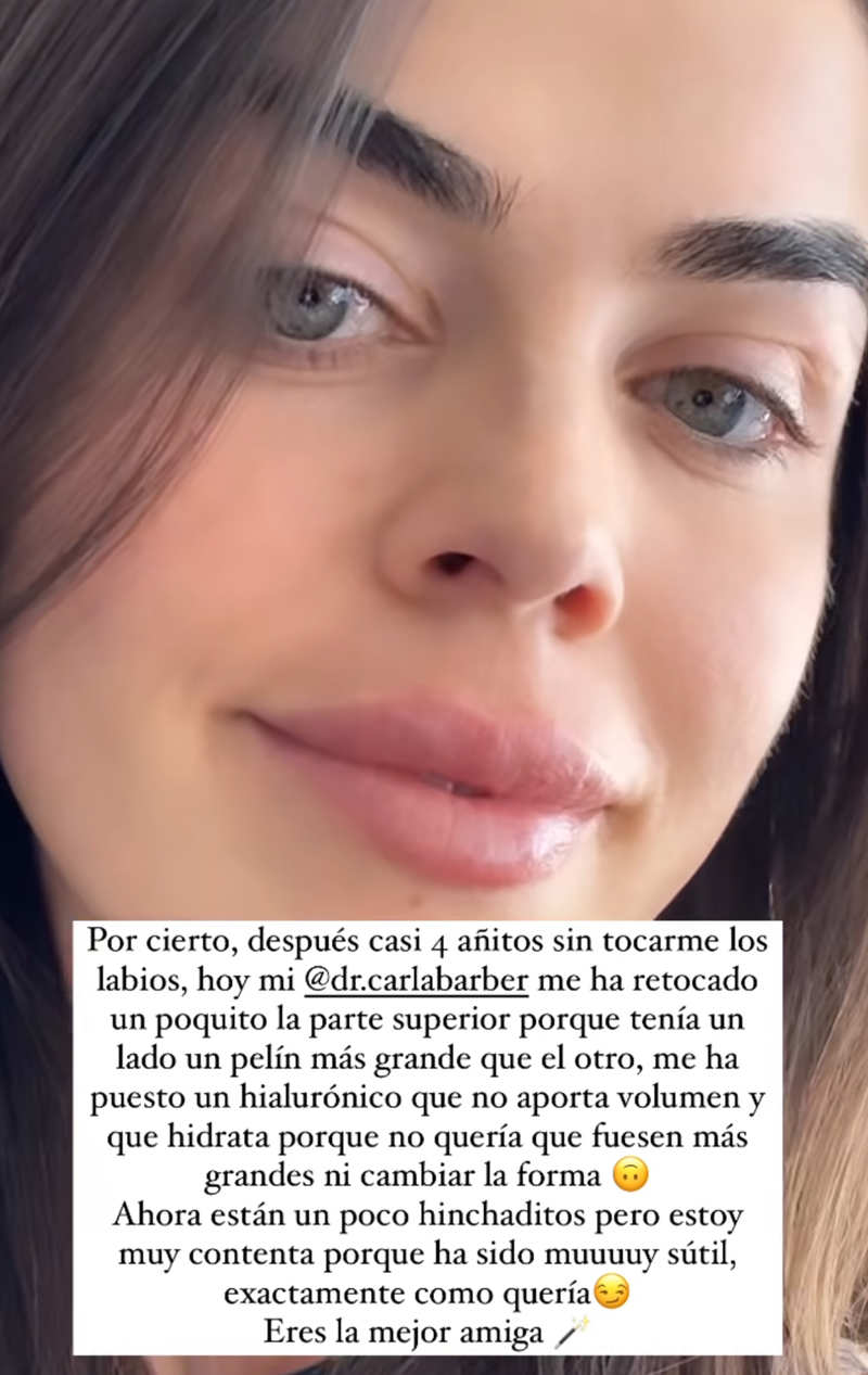 Los nuevos labios de Violeta Mangriñán retocados por Carla Barber 