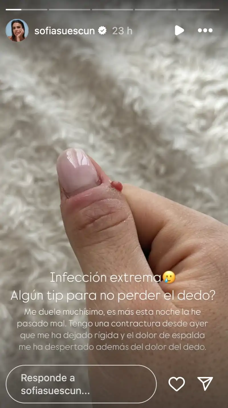 Sofía Suescun muestra la infección de su dedo