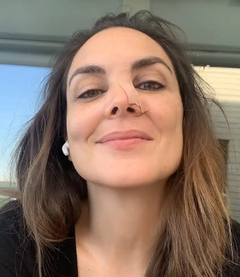 Mónica Carrillo con un apósito en la nariz
